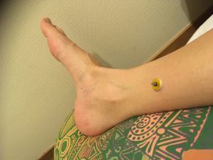 冷え取り☆セルフお灸